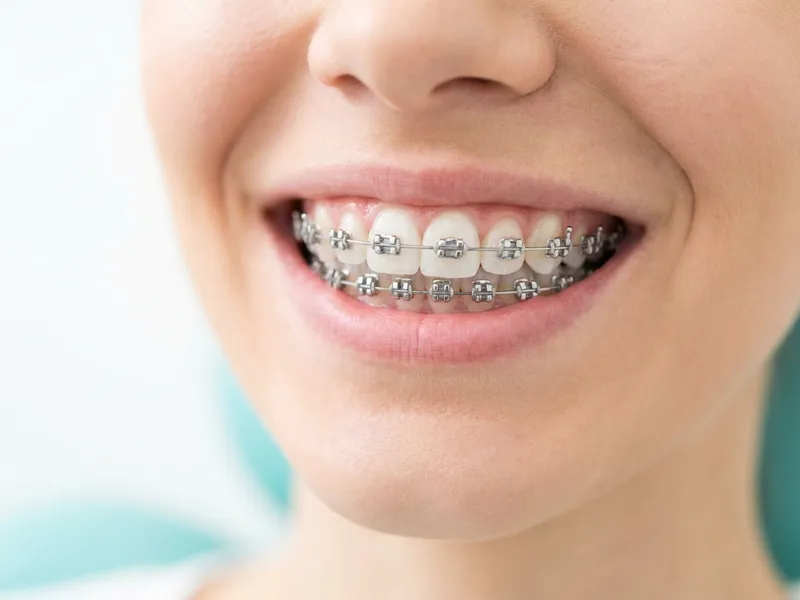Braces
