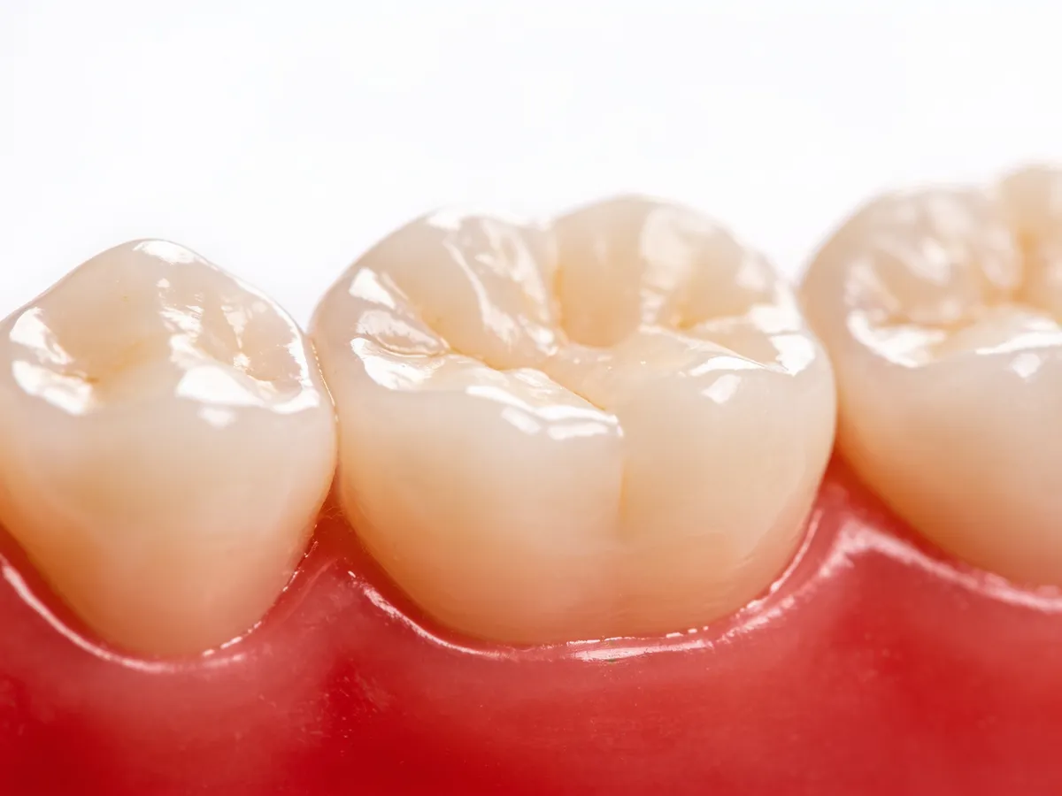 Dental Crowns