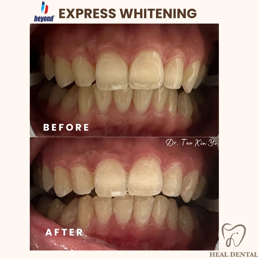 Teeth before and after Express Whitening, case EW005