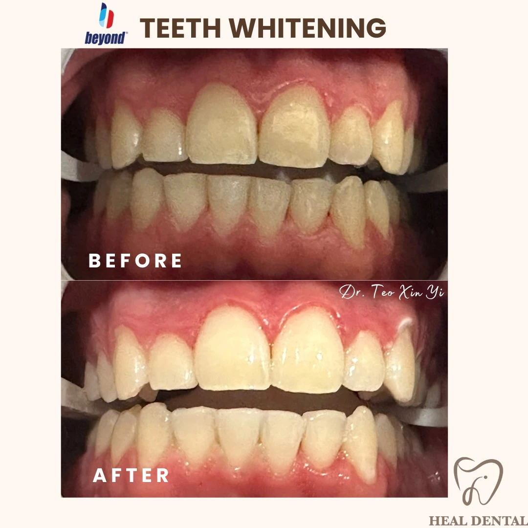 Teeth before and after Full Cycle Whitening, case TW006