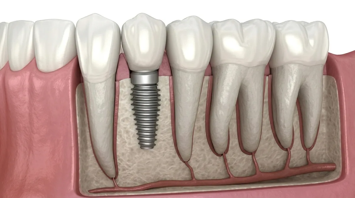Single tooth dental implant crown at Heal Dental Bukit Jalil